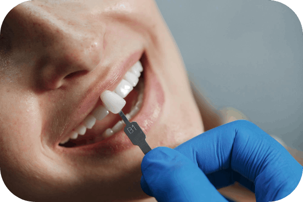 veneers treatment