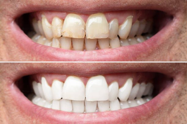 Teeth Whitening