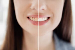 Does Teeth Whitening Damage Enamel