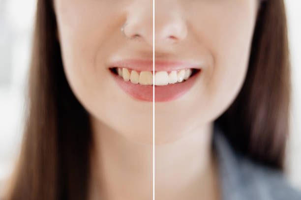 Does Teeth Whitening Damage Enamel