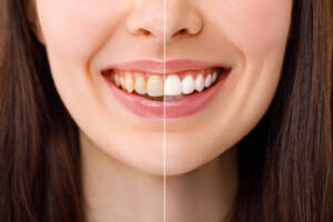 teeth whitening is permanent