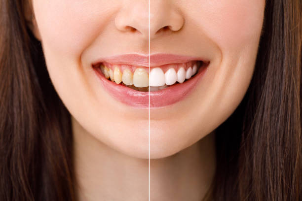 teeth whitening is permanent