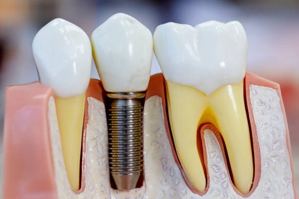 Dental Implant Years After Extraction