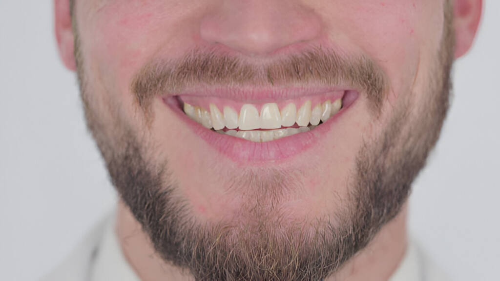 Composite Bonding for Crooked Teeth