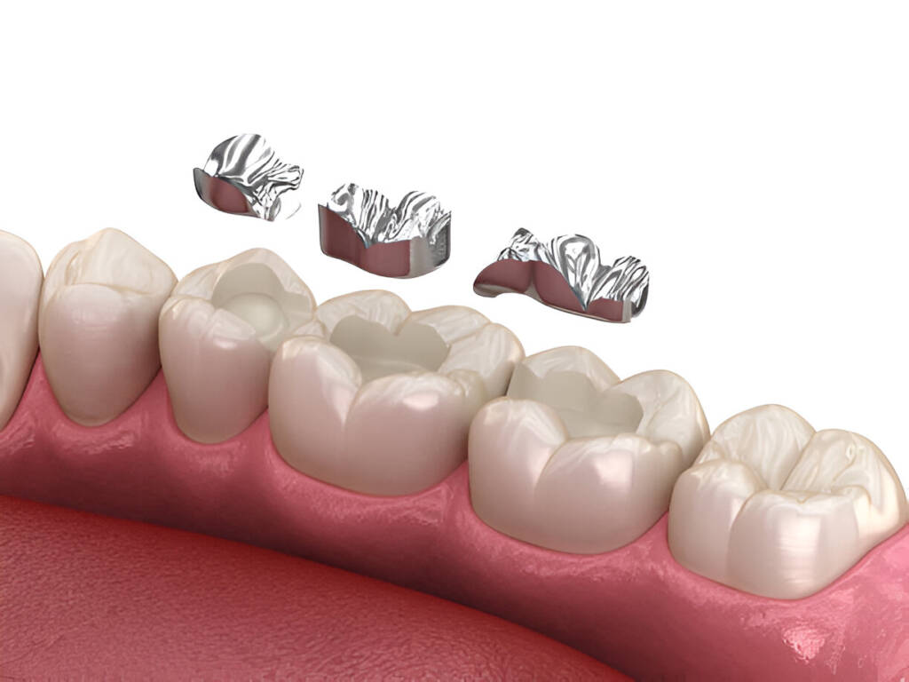 Composite Bonding for Filling Gaps