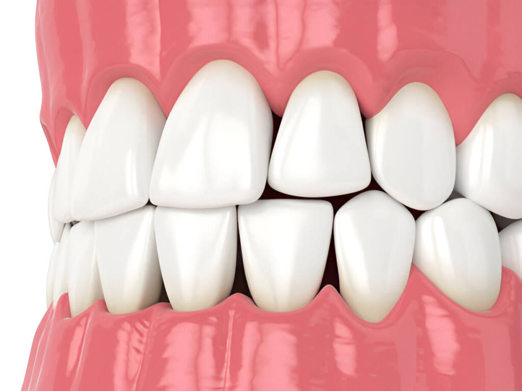 Composite Bonding Make Your Teeth Straight