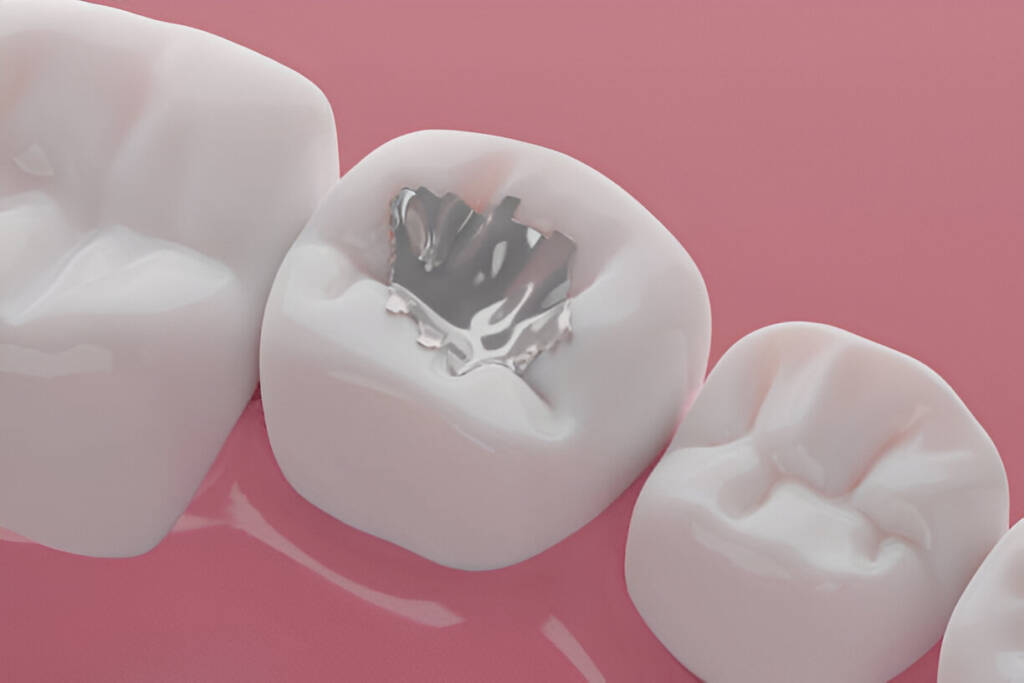 composite filling