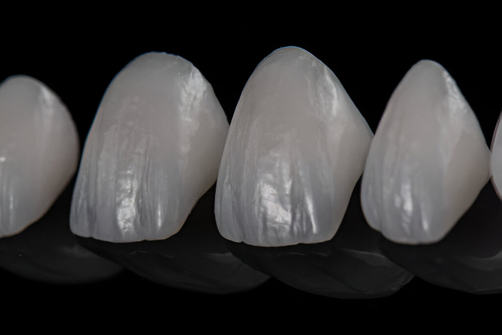 Can Veneers Be Done in One Day?