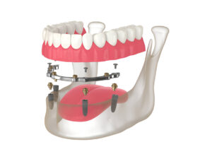 Dentures or Implants