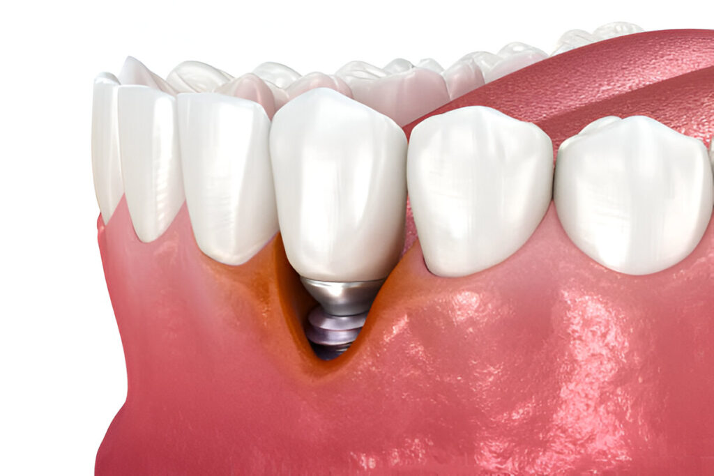 What are the Signs of Peri-Implantitis?