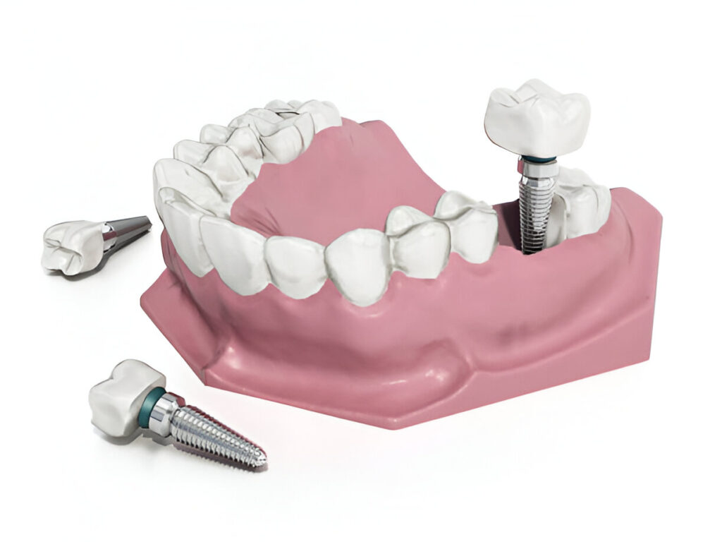 Dental Implant Surgery in the UK