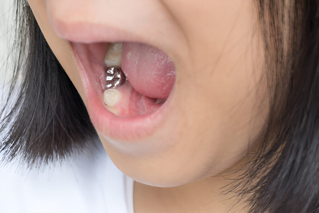 dental implants