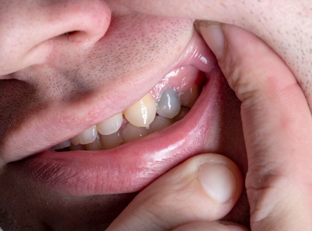 Is a Black Tooth an Emergency?