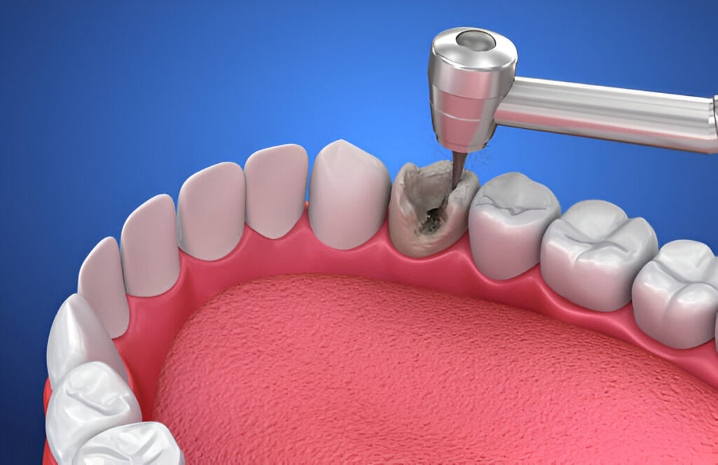 Dental Implants