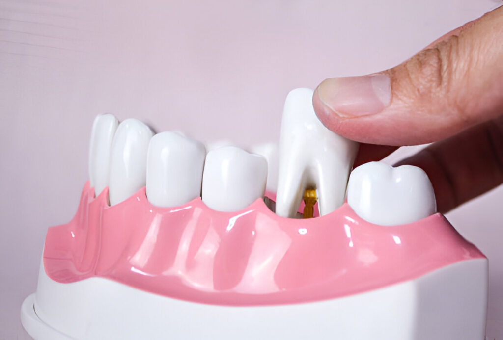 Gums Are Strong Enough for Implants?