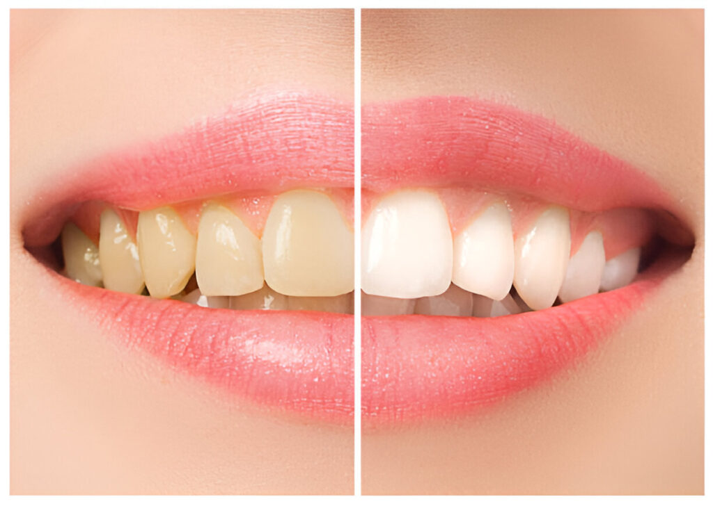 Teeth whitening