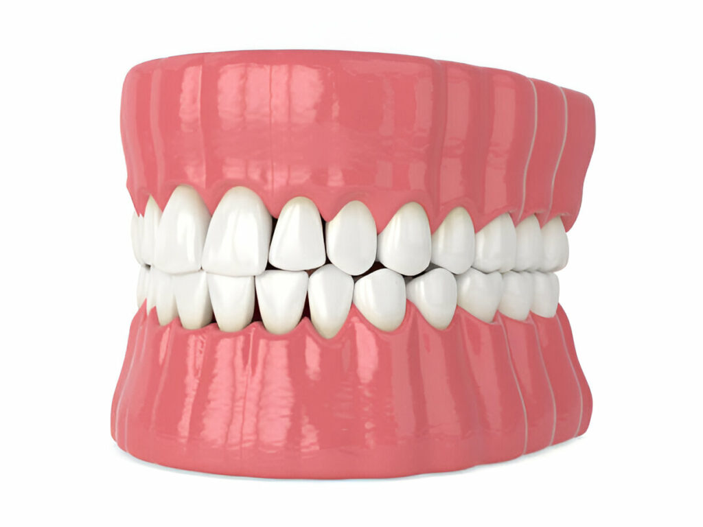 Composite Bonding