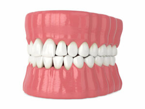 Composite Bonding