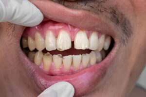 How Painful Is Composite Bonding?