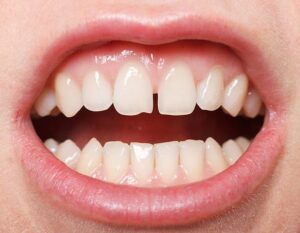 Can You Put Bonding on Front Teeth?