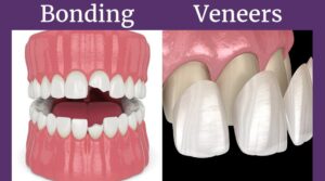 veneers vs composite bonding