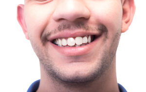 Is Composite Bonding Worth the Money?