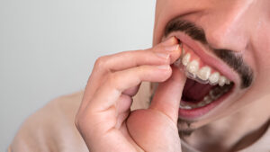 Does Invisalign fix your teeth forever?