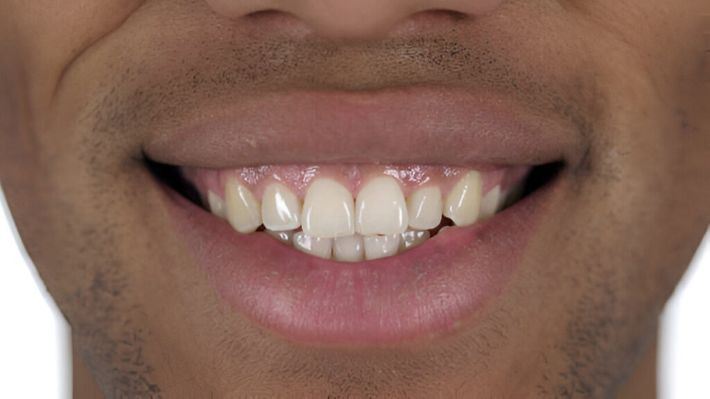 Can Composite Bonding Be Whitened?