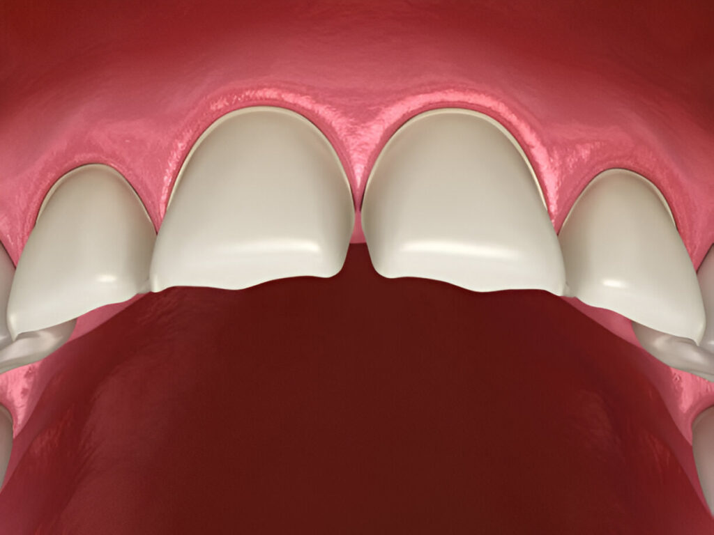 What Do Teeth Look Like When Composite Bonding Is Removed?