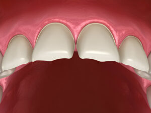 What Do Teeth Look Like When Composite Bonding Is Removed?