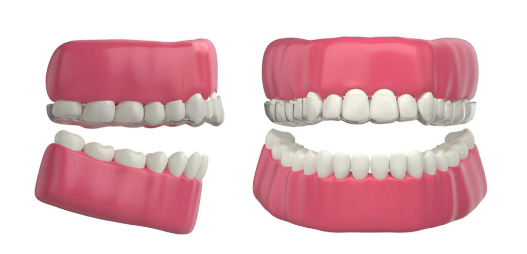 invisalign