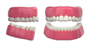 invisalign