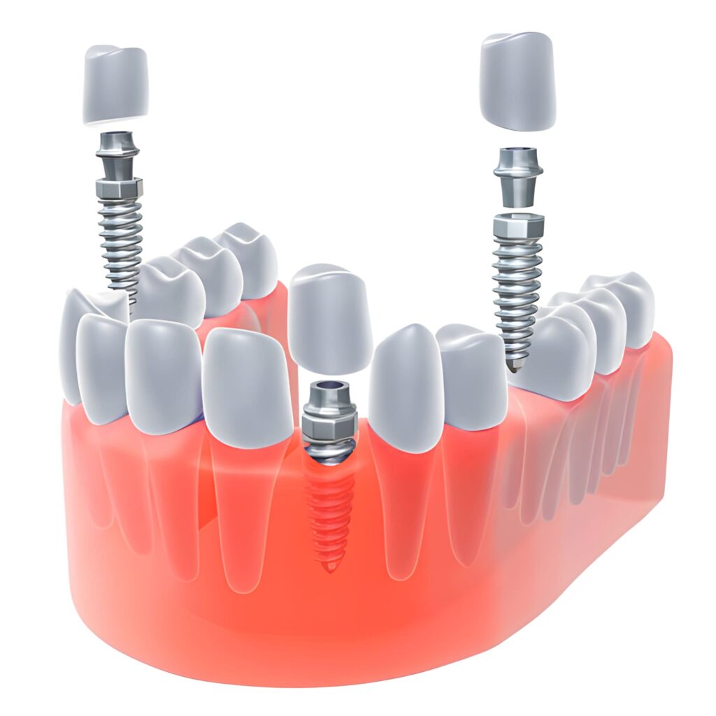 full set of dental implants