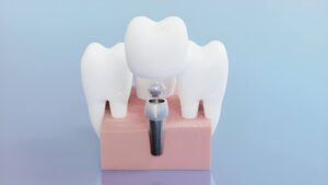 without teeth when getting implants?