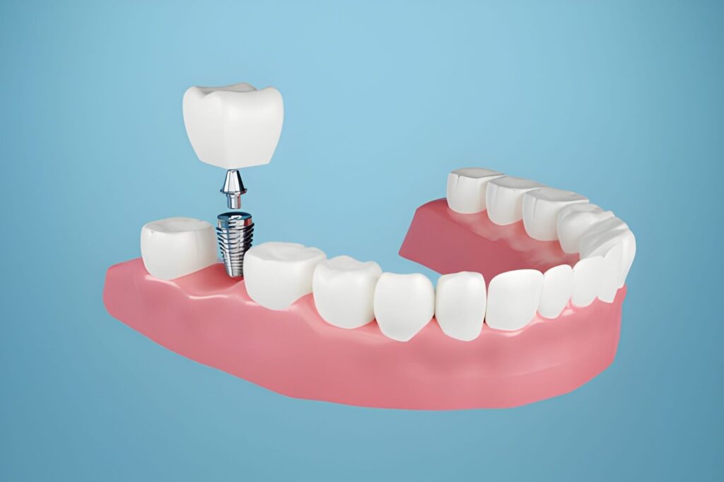 Painful Part of Dental Implants