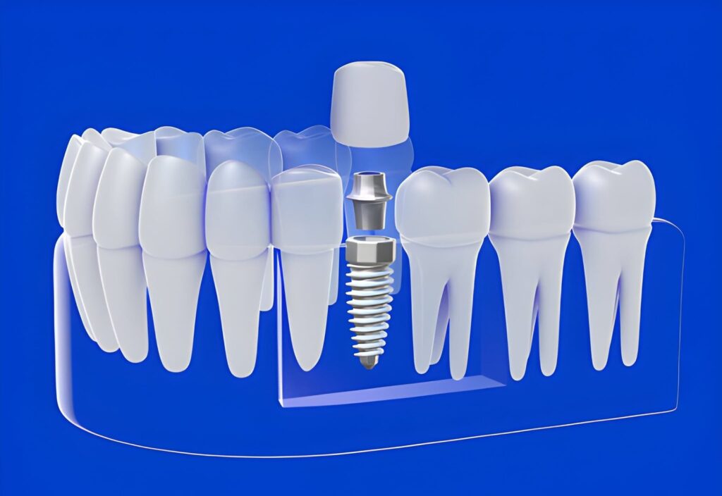 dental implants