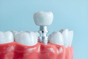 3/2 Rule for Dental Implants