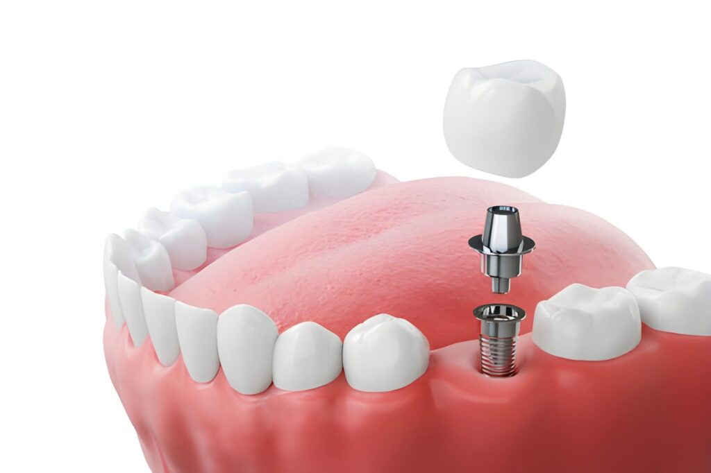Problem with Dental Implants