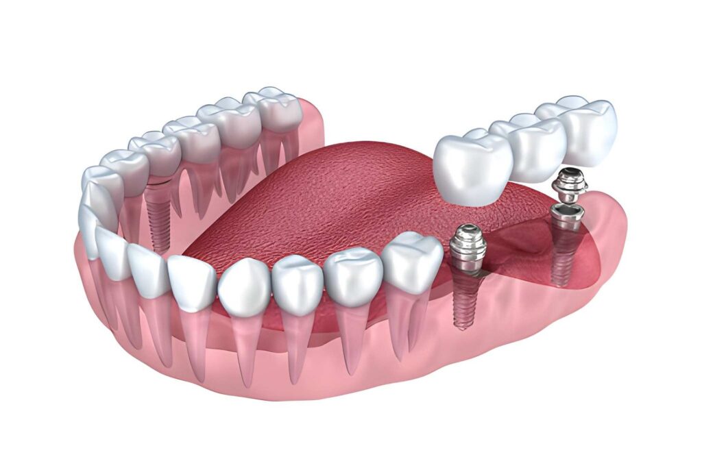 dental implant clinic in Aberdeen