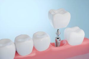 NHS dental implants in the UK