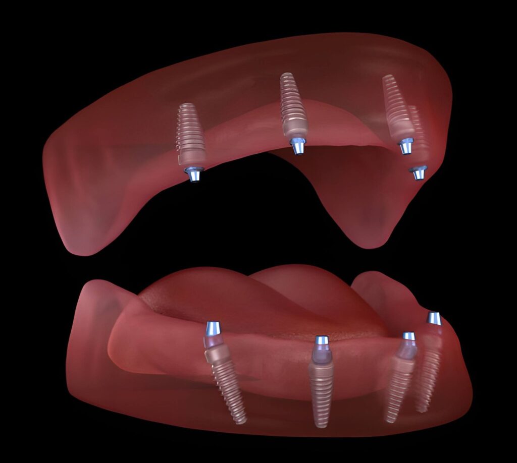 Does food get under All-on-4 implants