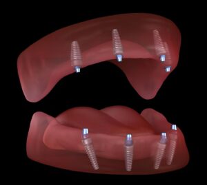 Does food get under All-on-4 implants